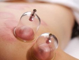 拔罐养生的好处 拔罐可以治什么？