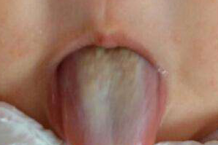 小孩子舌苔厚白是怎么回事呢?