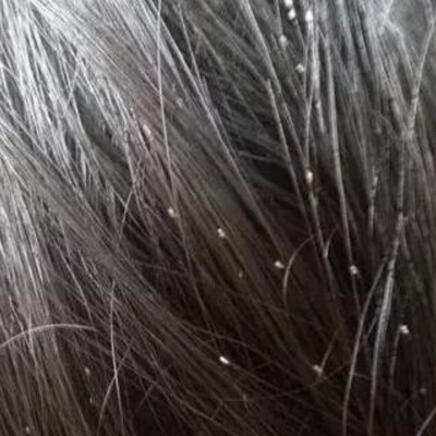 头虱是怎么来的 和头皮屑怎么区分